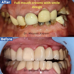 full mouth rehabilitation with metal ceramic crowns